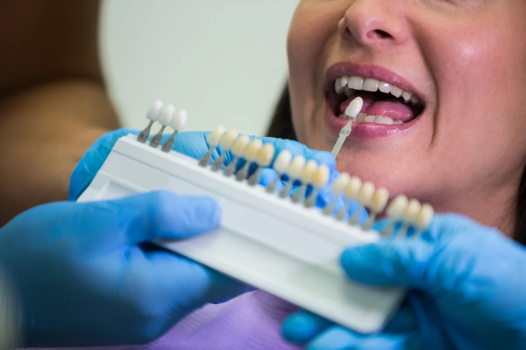Implantes Dentales para una sonrisa completa